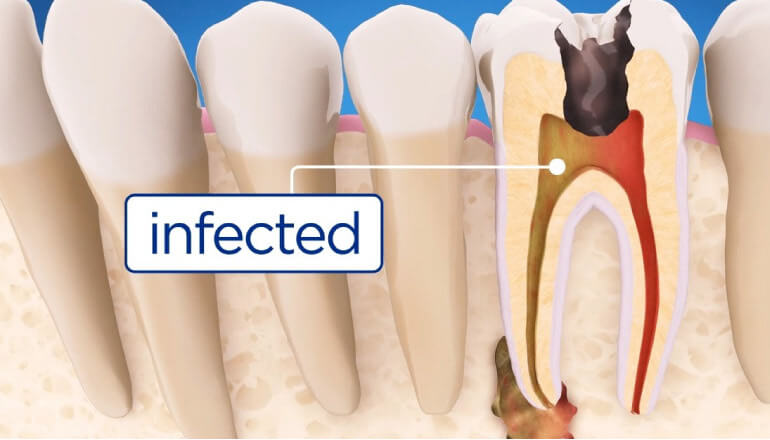 What Are the Three Stages of Root Canal Treatment?